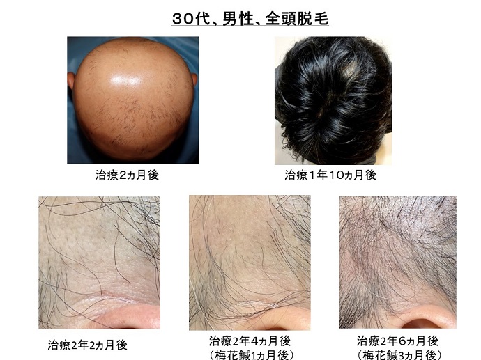円形脱毛症　病院